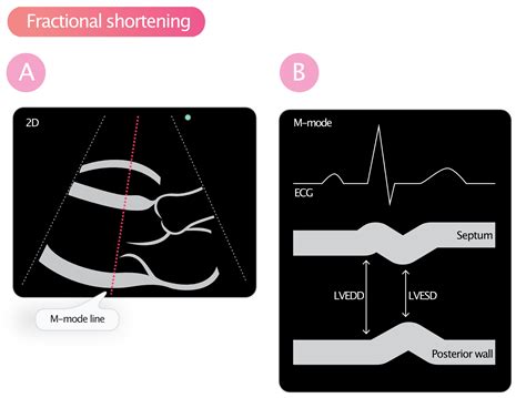 Shortening Fraction Echocardiogram