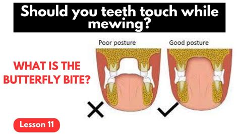 should teeth touch when mewing