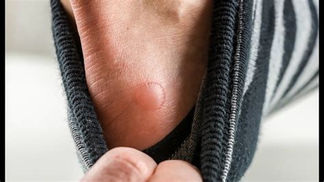 Should You Pop Blisters? The Surprising Truth Behind This Common Dilemma