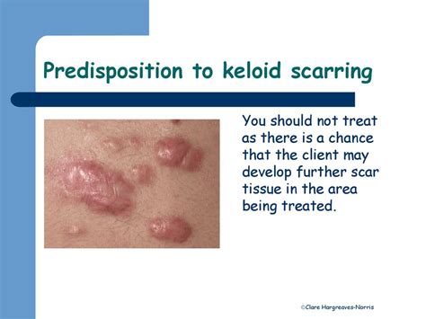 Should You Squeeze A Keloid