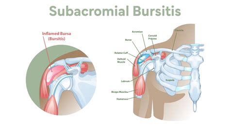 Shoulder Bursa Regrowth