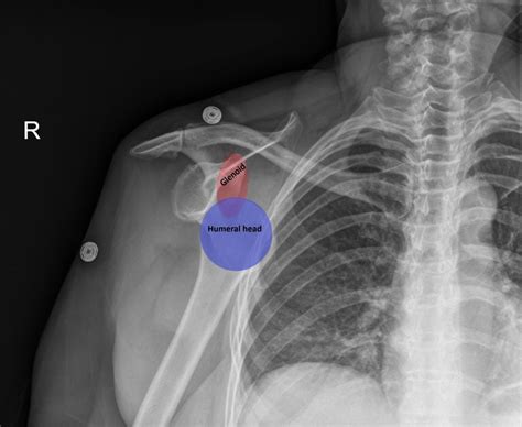 Shoulder Dislocation Reduction X Ray