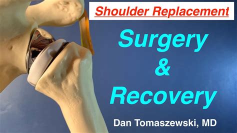 Shoulder Replacement Recovery: A Smooth Path to Mobility