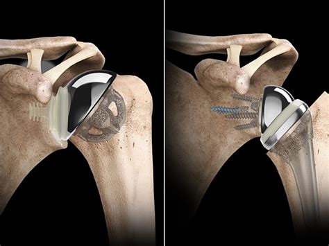 Shoulder Replacement Surgery: Regain Mobility and Reduce Pain