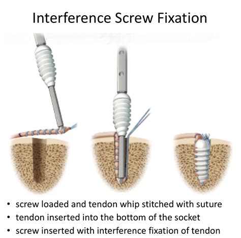 Shoulder Screw Surgery