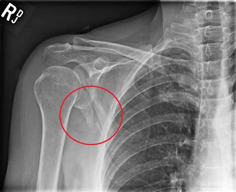 Shoulder X Ray Normal Vs Broken