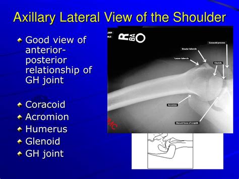 Shoulder X Ray Ppt