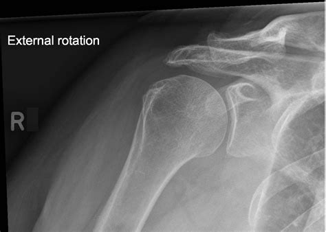 Understanding Shoulder X Rays of Normal Shoulder Anatomy