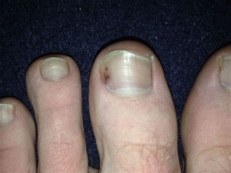 show me pictures of toenail melanoma