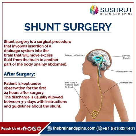 Understanding Shunt Surgery in Brain: A Lifesaving Intervention