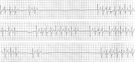 Understanding Sick Sinus Node Dysfunction: Causes and Treatments