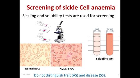 Accurate Diagnosis: The Importance of Sickle Cell Anemia Test