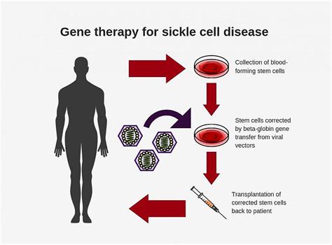 sickle cell anemia treatment