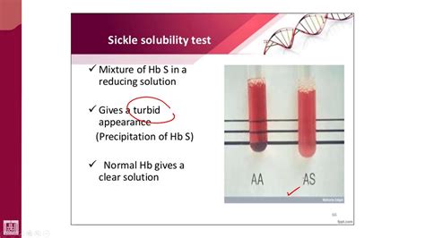 Sickle Cell Screening Test: Early Detection Saves Lives