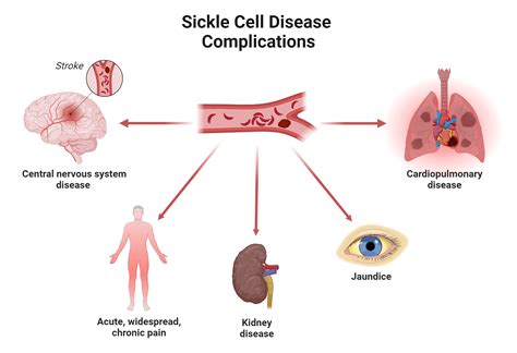 Lightning Learning Sickle Cell Disease — EM3 East Midlands Emergency