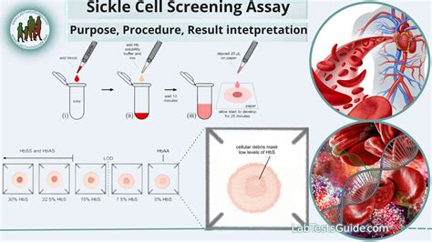 Sickle Cell Testing Labcorp