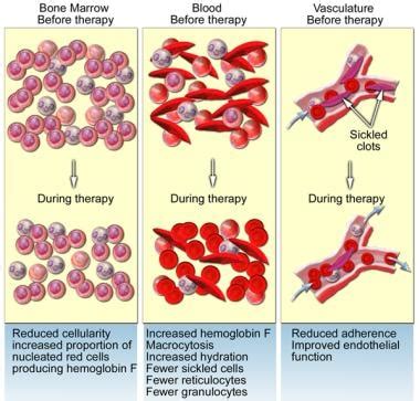 sickle cell treatment