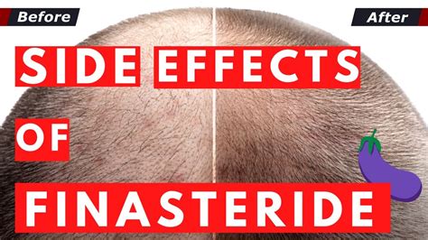 side affects of finasteride