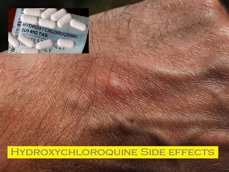 Understanding Side Effects for Hydroxychloroquine Treatment Options