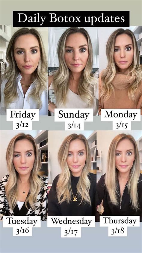 side effects of botox in face before and after