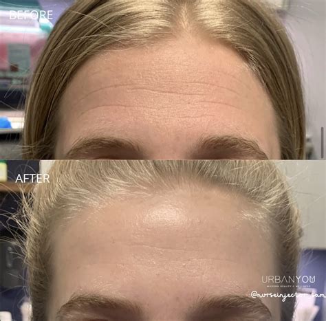 side effects of botox in forehead before and after