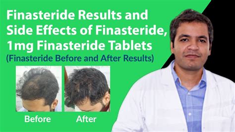 side effects of finasteride 1mg