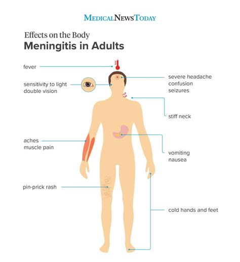 menigitis healthtips What you need to know... Share with someone