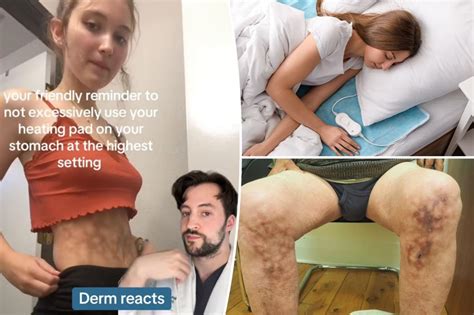 Side Effects Of Prolonged Heating Pad Use