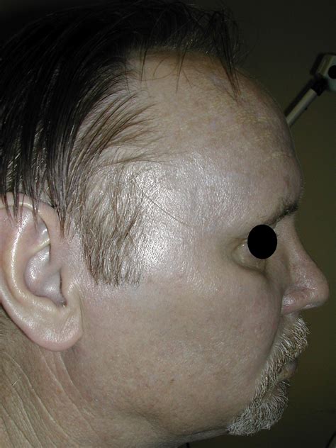 Side Effects Of Too Much Colloidal Silver