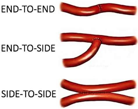 side to side end to end anastomosis