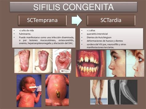 sifilis gestacional clinic barcelona