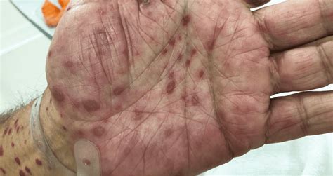 sifilis secundaria lesoes de pele