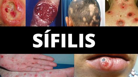 sifilis sintomas