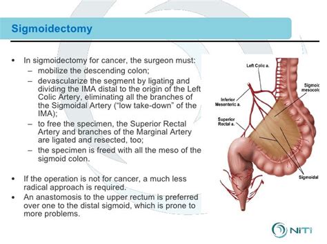 sigmoidectomy with primary anastomosis