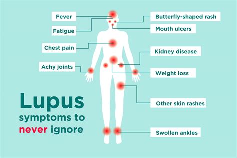 Lupus Symptoms; 10 Warning Signs and Symptoms of Lupus