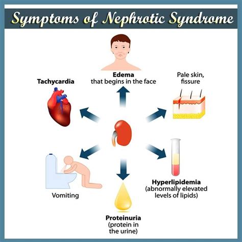 Nephrotic Syndrome Global Patient Transfer