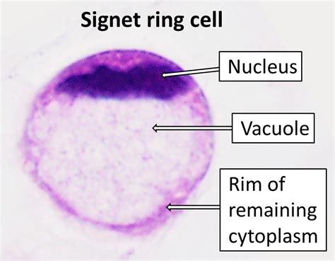signet cell ring