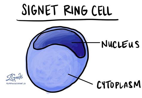 signet cells