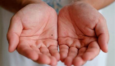Los lunares en las manos o los pies pueden ser cancerígenos | Noticias