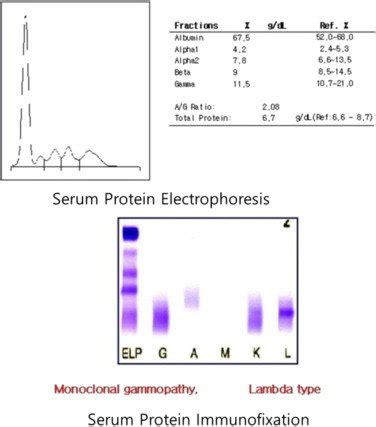 significance of serum protein electrophoresis