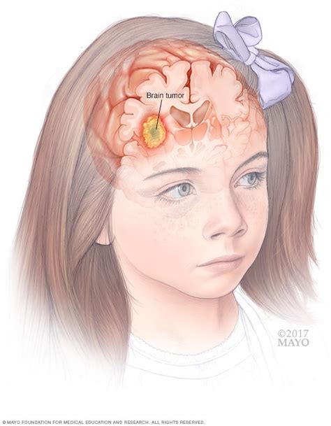Tumor Symptoms Of Brain Tumor In Children