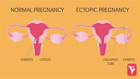 Early Signs Of Ectopic Pregnancy At 4 Weeks PregnancyWalls