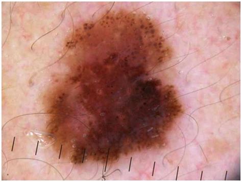 signs melanoma has metastasized