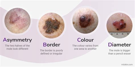 signs of a melanoma