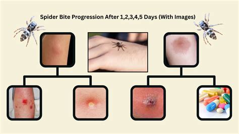 Spider Bite Alert: 7 Surprising Signs of a Spider Bite You Shouldn't Ignore