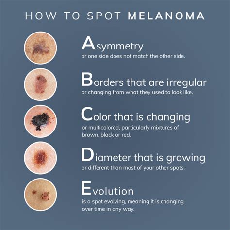 signs of advanced melanoma
