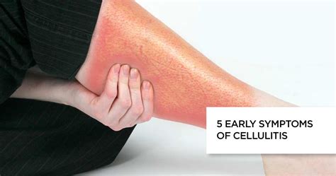Don't Miss These Common Signs of Cellulitis: A Guide to Early Detection and Treatment
