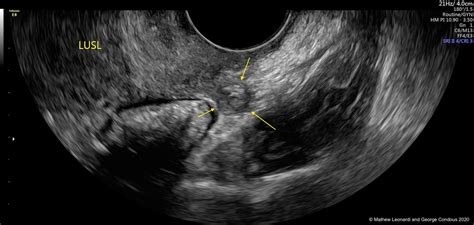 signs of endometriosis on ultrasound