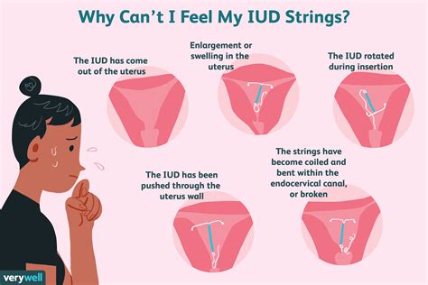 signs of iud infection mirena