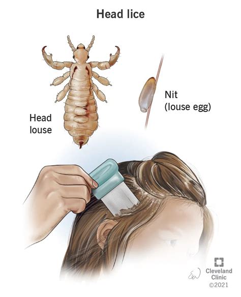 signs of lice in humans